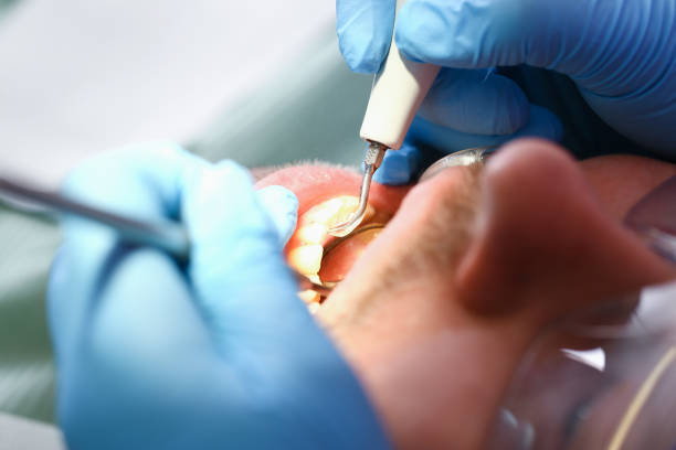 Best Emergency Wisdom Tooth Extraction in Oak Hill, WV